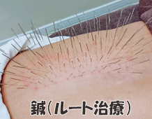 鍼 ルート治療